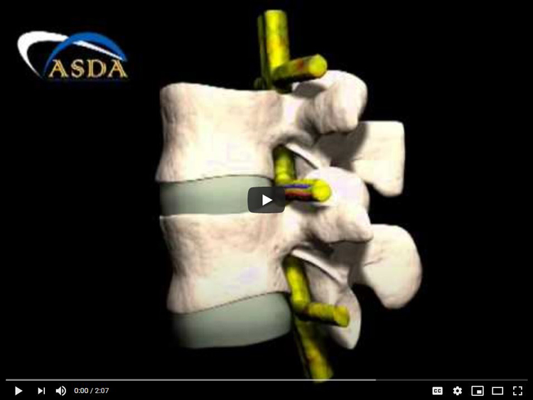 Spinal Decompression in New Port Richey FL